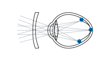 Spetsiaalne müoopia klaas